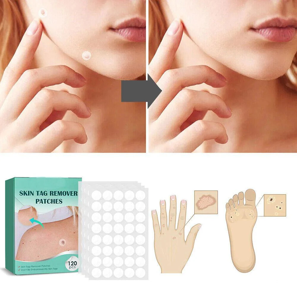 SkinClear - Patch for the removal of spots and warts Kalsten 2