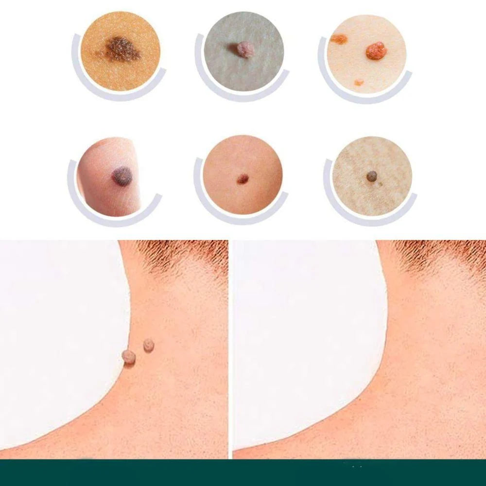 SkinClear - Patch for the removal of spots and warts Kalsten 6
