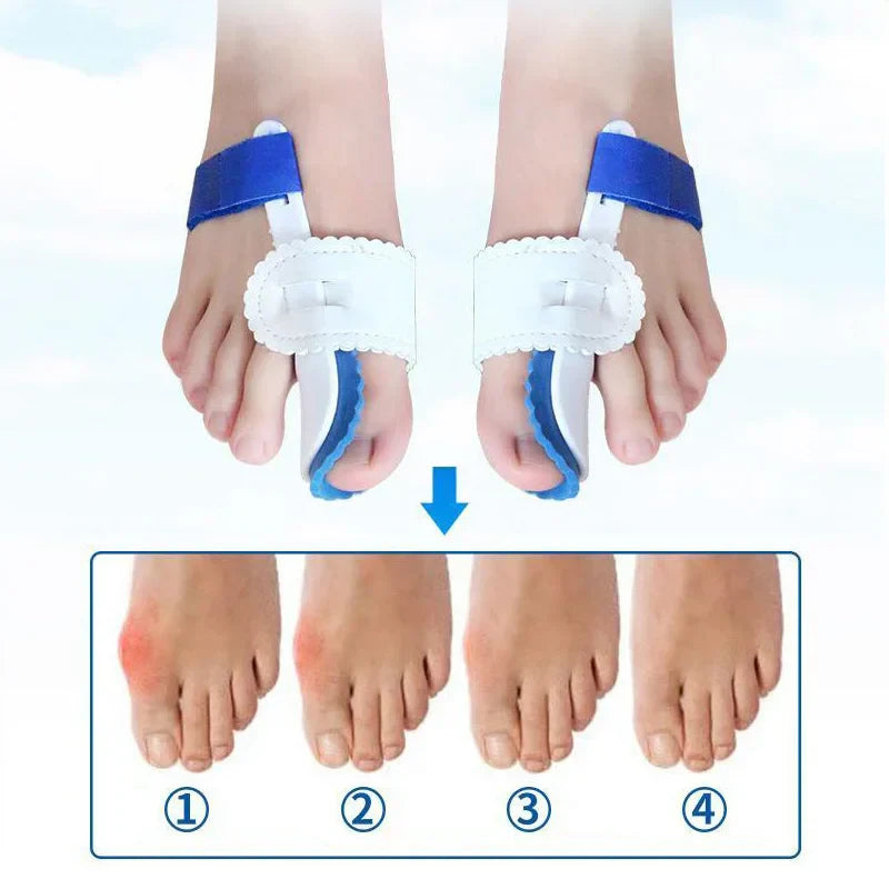 Zehenspreizer zur Korrektur von Hallux Valgus – Silikon, Einheitsgröße, schmerzlindernd 1