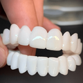 Dental Prosthesis with White Veneers for Natural, Radiant Smile 0