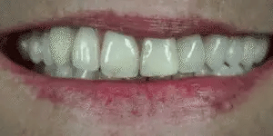 NovaBright Snap On Veneers For Upper And Lower Teeth Instant Natural Smile 2