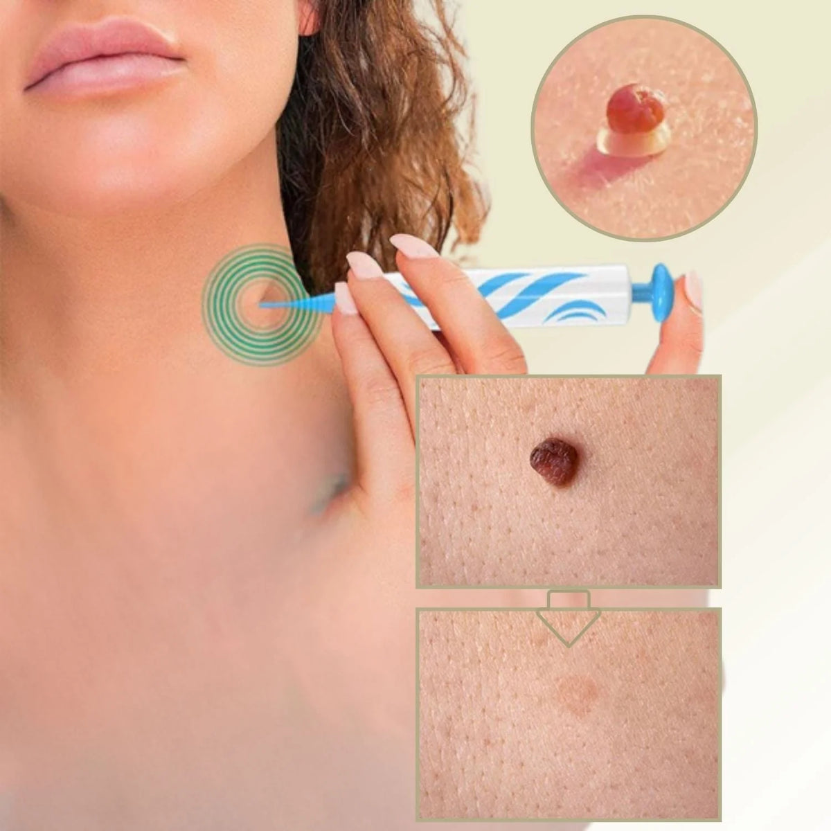 Pain-Free Wart Remover for Home Use – Effective Plantar Wart Removal, Non-Invasive Wart Freeze Off Solution 0