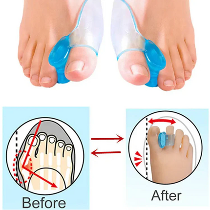 Silikon Gel Zehenspreizer für Hallux Valgus – 2 Stück, Wiederverwendbar, Komfortabel 6